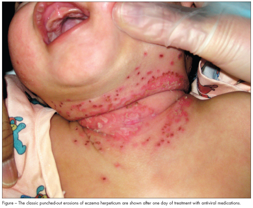 eczema, atopic dermatitis