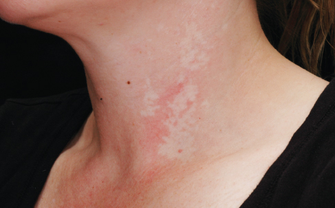 nevus anemicus