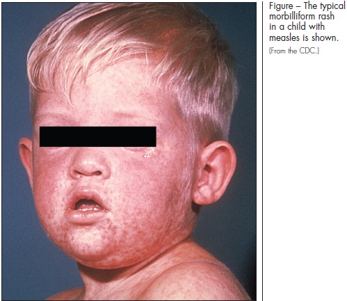 child with measles