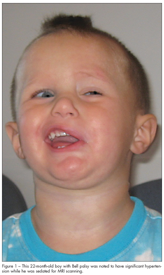 RENAL ARTERY STENOSIS 