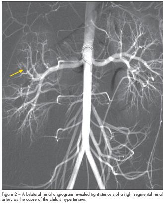 RENAL ARTERY STENOSIS 