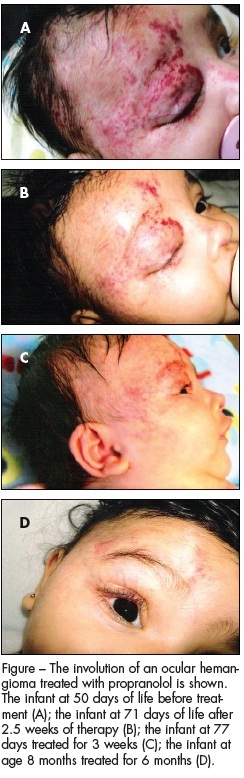infantile hemangioma