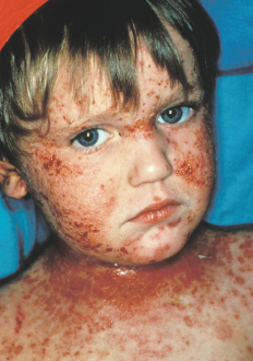 eczema, atopic dermatitis