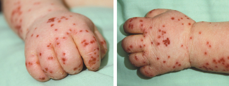 eczema, atopic dermatitis