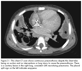 continuous pneumothorax