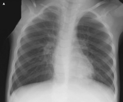 Congenital pseudoarthrosis of the clavicle