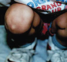 Infrapatellar Bursitis