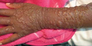 eosinophilia arm