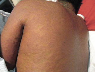 eosinophilia back