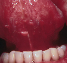 sublingual condylomata