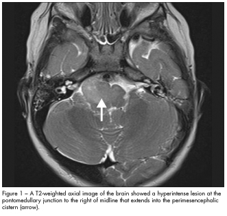 hyperintense lesion