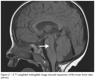 expansion lower brain