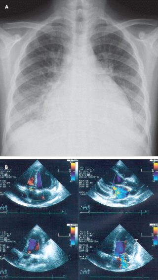pericardial effusion