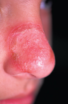 dermatophyte infection