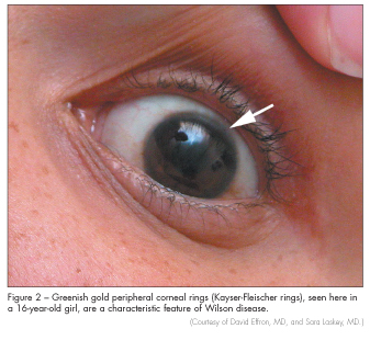 corneal rings Kayser fleischer