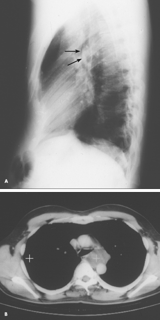 esophageal foregut cyst