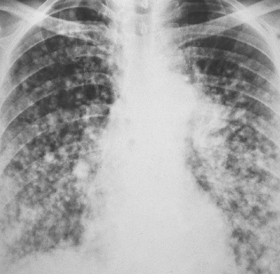 bronchoalveolar carcinoma