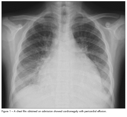 cardiomegaly pericardial effusion
