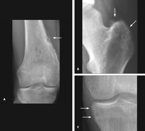 multifocal osteomyelitis