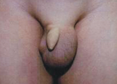 Indirect Inguinal Hernia  