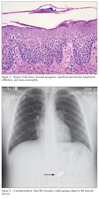 spongiosis perivascular lymphocytic infiltration