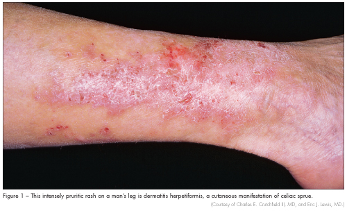 dermatitis herpetformis sprue