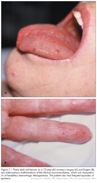 arteriovenous malformations dermal microvasculature