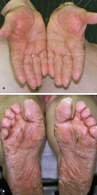 Pityriasis Rubra Pilaris 