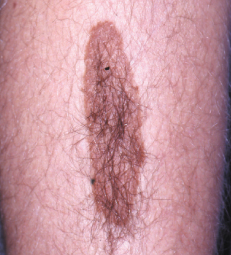 congenital hairy nevus