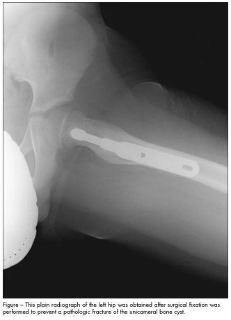 pathologic fracture prevention