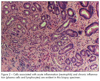 Eosinophilic gastritis