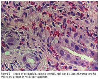 Eosinophilic gastritis