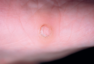 eccrine poroma