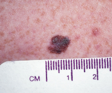 Melanoma