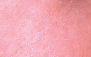 Miliaria crystallina