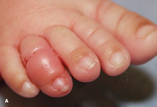 Hair Tourniquet Syndrome