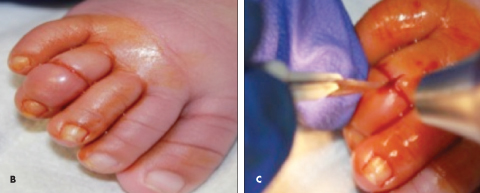 Hair Tourniquet Syndrome