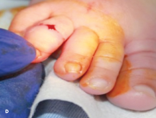 Hair Tourniquet Syndrome