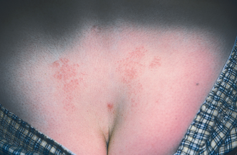 Factitial dermatitis
