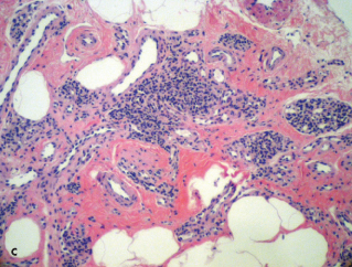 Glomus Tumor