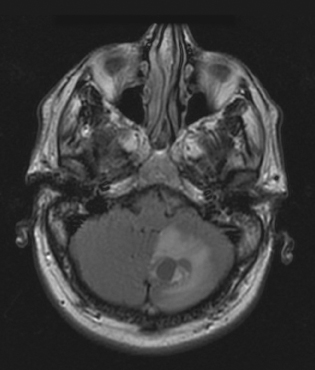Von Hippel-Lindau  Syndrome 