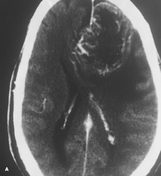 Cutaneous T-Cell Lymphoma