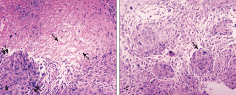 Cutaneous T-Cell Lymphoma