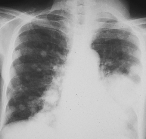 Renal Cell Carcinoma, lung