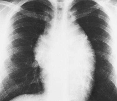 Renal Cell Carcinoma, lung