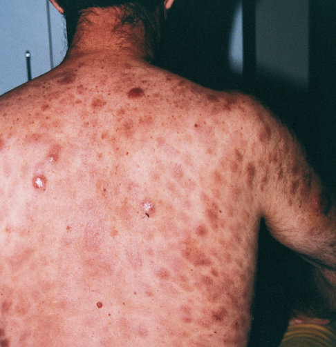 Cutaneous T-Cell Lymphoma