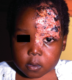 HIV, viral infection