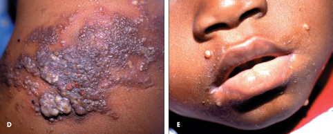 HIV, bacterial infection