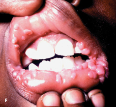 HIV, bacterial infection