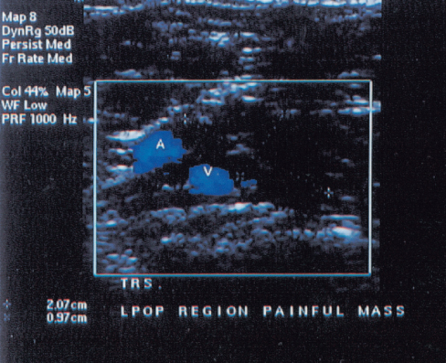 baker's cyst